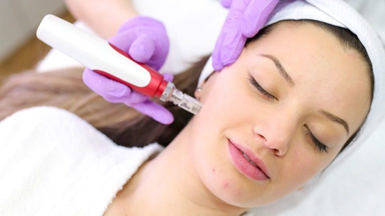 micro needling médical