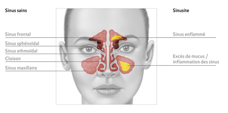 découvrez des méthodes naturelles pour soulager la sinusite efficacement. apprenez des remèdes à base de plantes, des techniques de gestion du stress et des astuces de style de vie qui peuvent aider à réduire l'inconfort et favoriser une meilleure respiration.