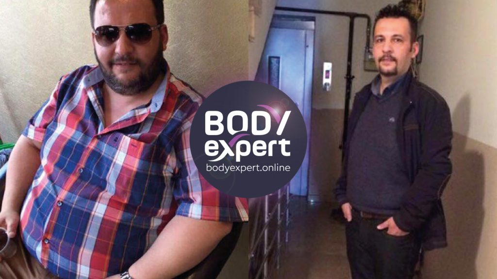 découvrez les distinctions clés entre la sleeve et le bypass, deux interventions chirurgicales majeures pour la perte de poids, afin de choisir la solution la mieux adaptée à vos besoins.